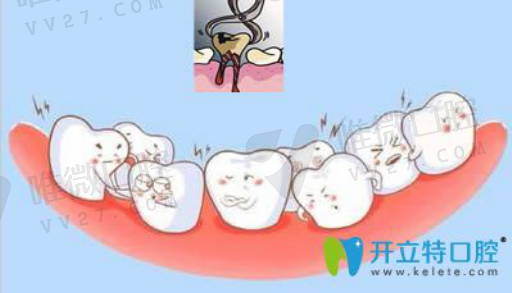 活动义齿一般能用几年（活动义齿几年换一次）(图1)
